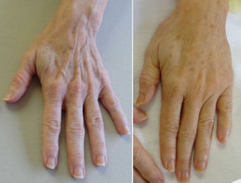 Radiesse to the hands before 621362