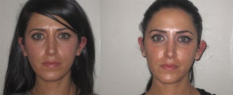 Facial Rejuvenation, non-surgical before 450123