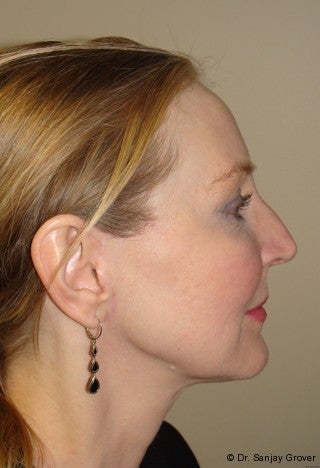Facelift with browlift and lower blephorplasty 617176