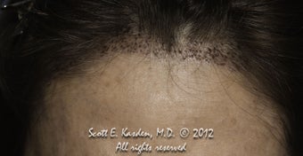 AccuGraft Hair Transplant after 589692
