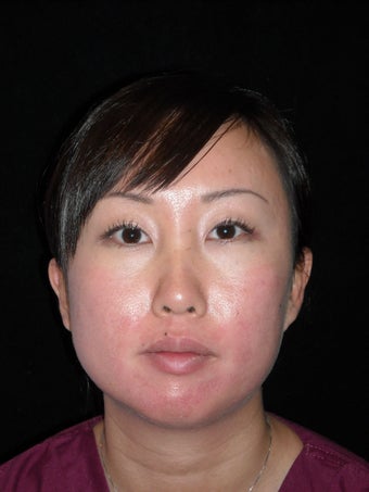 Lip enhancement before 228304