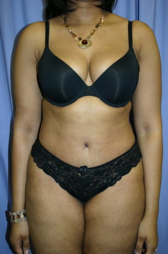 Tummy Tuck after 347086