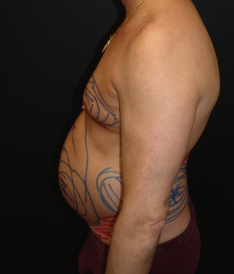 Tummy Liposuction before 230734