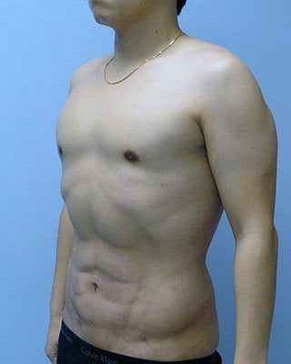VASER Liposuction (HiDef) after 570299