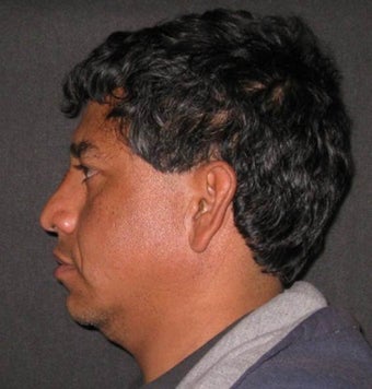 Rhinoplasty, Nasal Fracture Repair 539992