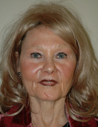 High SMAS Face Lift, Neck Lift, Perioral Dermabrasion before 468008