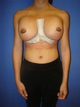 Revision Breast Surgery 356593