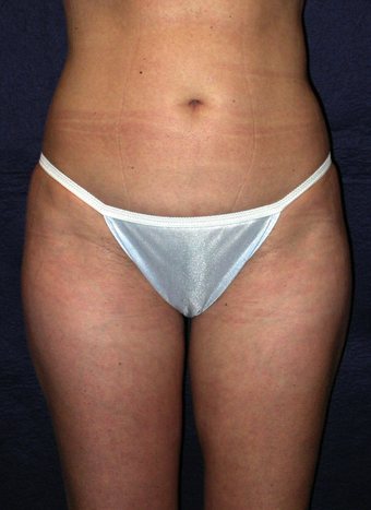 Tummy Liposuction after 229699