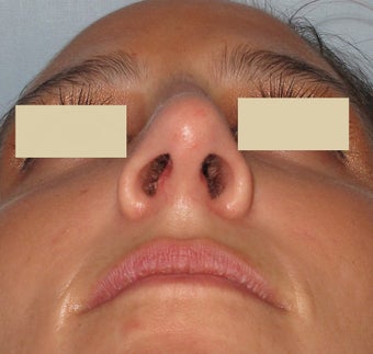 Rhinoplasty, Broken Nose after 127193
