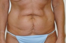 Tummy Tuck (Lipo Abdominoplasty) before 244000