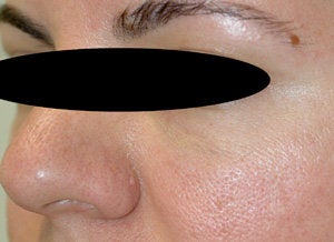 Restylane for eye bags after 199422