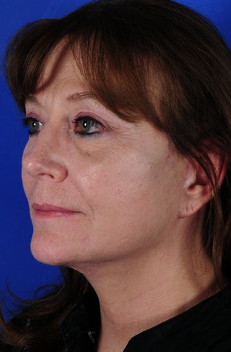 Neck Lift after 322074