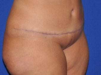 Abdominal Panniculectomy after 582153