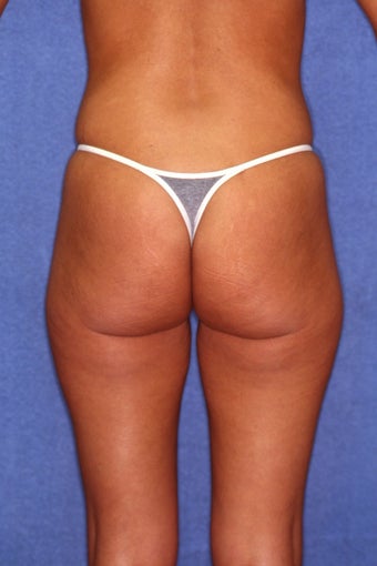 Tummy Tuck with Liposuction 410981