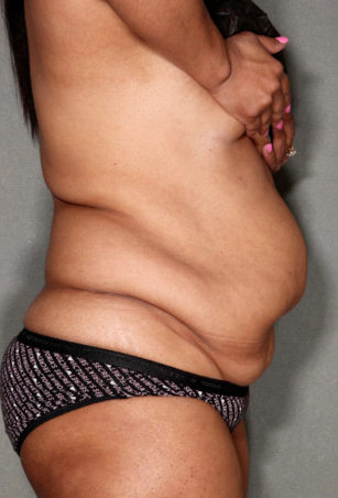 SmartLipo™ 529445