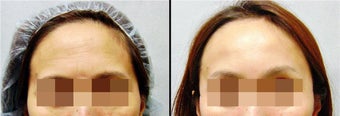 Endoscopic Brow Lift before 649400