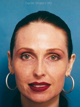 Full face erbium laser resurfacing after 250228