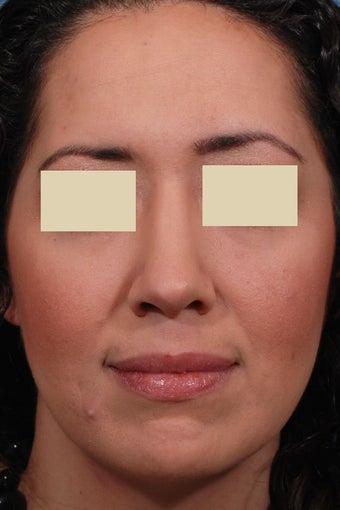 Rhinoplasty after 91600