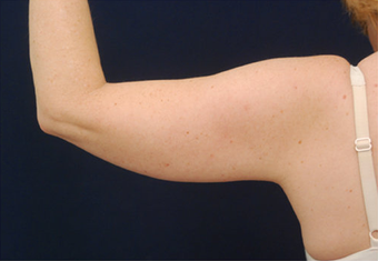 Liposuction 397170