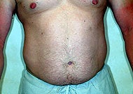 Liposuction before 74772