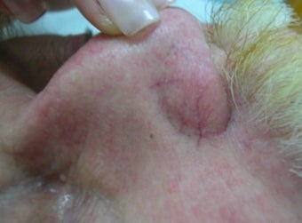 Vbeam for veins on nose before 374574
