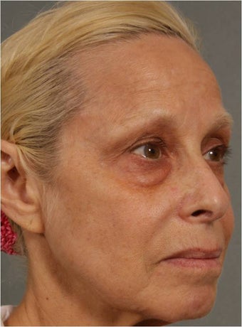 60 Year Old Female treated for under eye puffiness, sagging cheeks and frown lines non surgically 640083