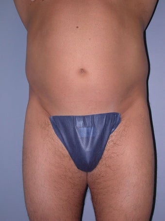 Liposuction before 581412