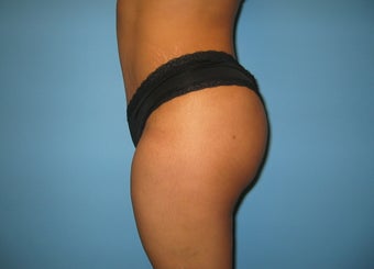 Buttock augmentation (Brazilian buttock lift) after 150355