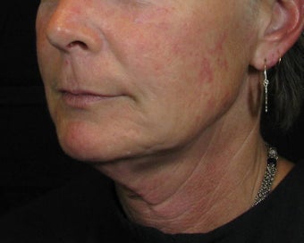 Facelift before 246960