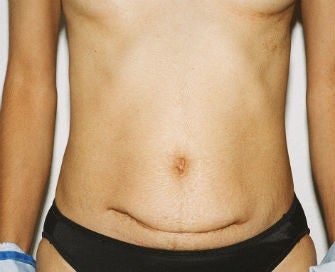 Abdominoplasty Revision before 493649