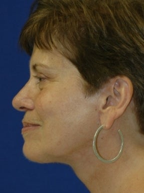 Lower Facelift and Necklift with Platysmaplasty after 242881