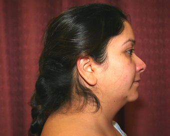 liposuction of neck & jaw line for women in Los Angeles 583586