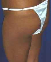 Brazilian Butt Lift before 101295