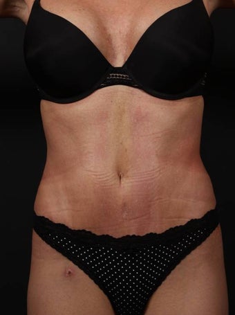 Full tummy tuck revision after 356434