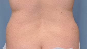 Liposuction before 293854