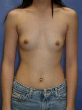 Breast Augmentation before 356554