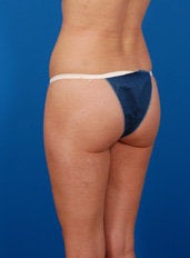 Brazilian Butt Lift before 437014