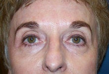 Pearl Fractional Laser after 156996