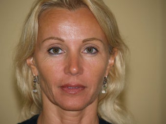 Sculptra after 296029
