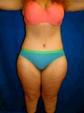 Extended Tummy Tuck Surgery after 147833