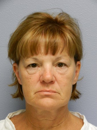 Lower Face Lift with Neck Lift before 608815
