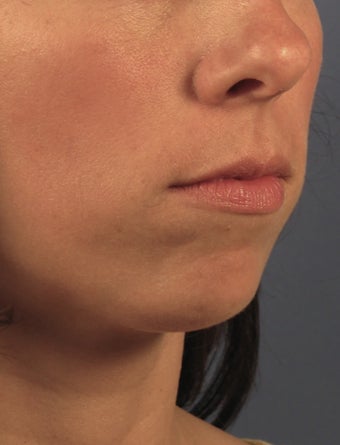 Chin Implant before 414148