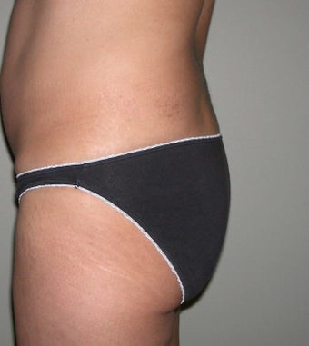 Butt implant augmentation before 266046