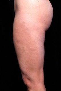 Cellulaze before 614469