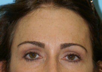 Forehead Lift after 581211