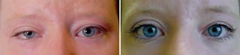 Revisional ptosis repair of left upper eyelid before 155083