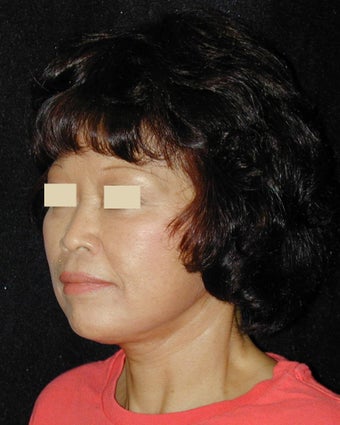 Facelift / Necklift after 103848