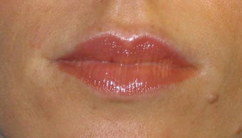 Juvederm Lip Augmentation after 84412