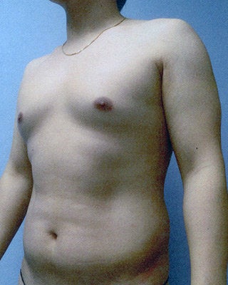 VASER Liposuction (HiDef) before 570299