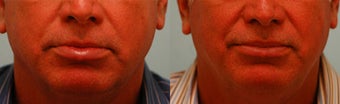 Lower Lip Reduction before 197281